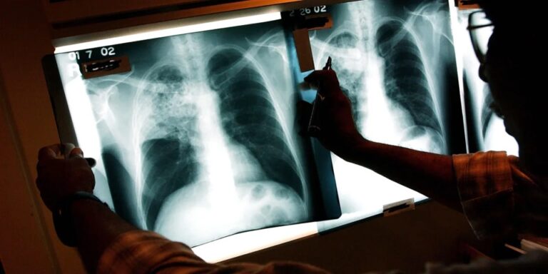 Kansas Tuberculosis Outbreak, Largest in US History, Hits 67 Active Cases Across Two Counties – Latest Details