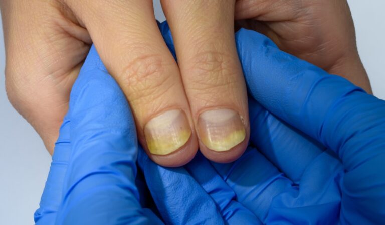 Doctor Reveals 7 Health Conditions You Can Spot By Just Checking Your Nails