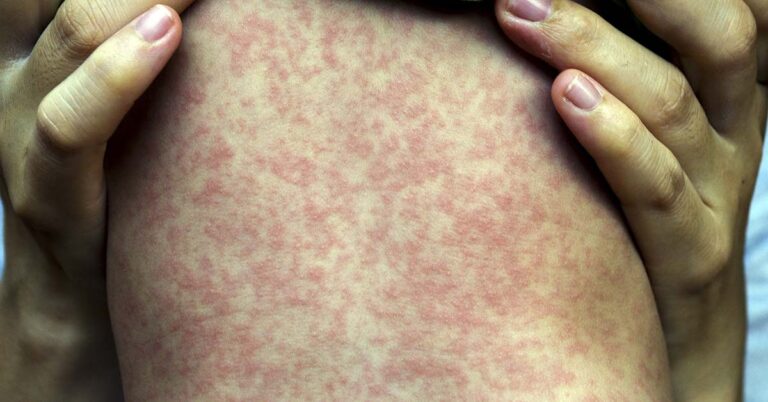 This is What Measles Does to Your Body