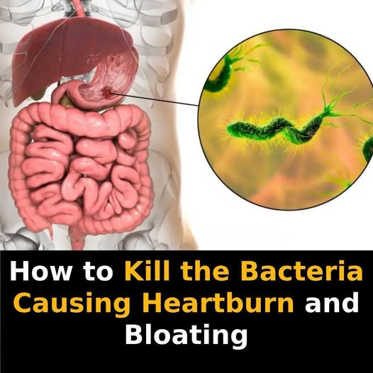 How to treat H. Pylori Bacteria Causing Heartburn And Bloating + Natural Remedies