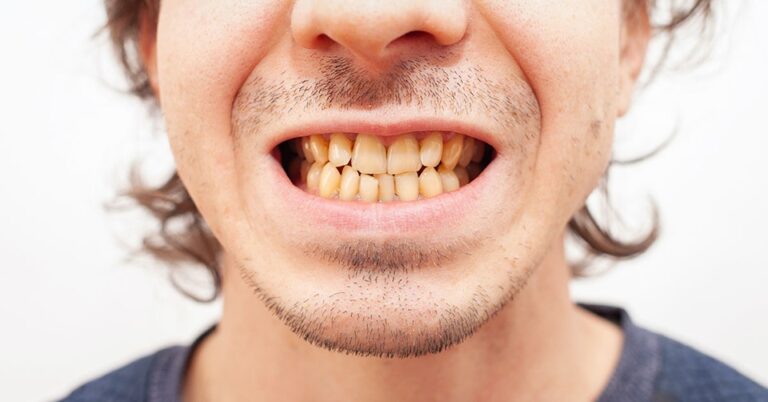 Dentist Explains 7 Key Causes of Yellowing Teeth and How to Prevent It